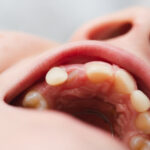 Modelo dental mostrando el espacio de un diente perdido y opciones de tratamiento como el implante.
