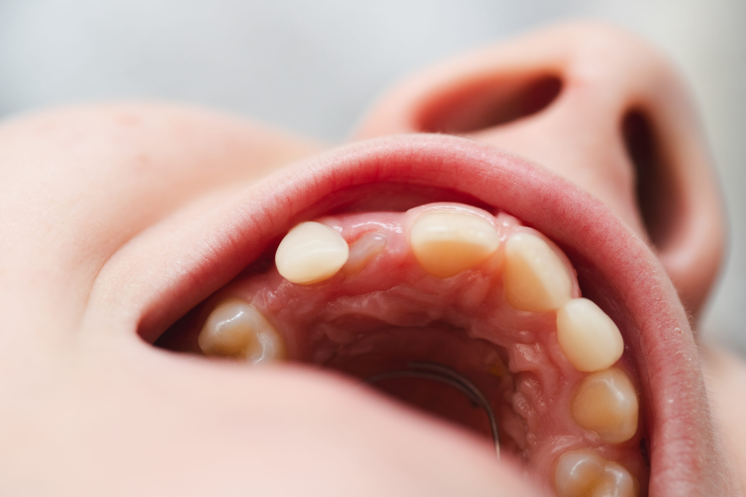 Modelo dental mostrando el espacio de un diente perdido y opciones de tratamiento como el implante.