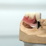 ¿Estás buscando una solución eficaz y duradera para reemplazar dientes perdidos? En Salvador Rico Odontología Integral te ofrecemos los mejores implantes en Vigo, con una atención personalizada, tecnología avanzada y resultados que transforman sonrisas. ¿Qué son los implantes dentales? Los implantes dentales son raíces artificiales de titanio que se colocan en el hueso maxilar o mandibular para sustituir dientes perdidos. Sobre ellos se coloca una corona que imita a la perfección la forma y función del diente natural. Son una de las opciones más seguras y duraderas en odontología, ya que ofrecen una solución fija, estética y funcional. Ventajas de los implantes dentales Optar por implantes en Vigo con un equipo profesional como el de nuestra clínica ofrece múltiples beneficios: Estabilidad y durabilidad: los implantes pueden durar toda la vida con los cuidados adecuados. Estética natural: la corona sobre implante se diseña para integrarse perfectamente con tu sonrisa. Prevención de la pérdida ósea: al estimular el hueso, se evita su reabsorción tras la pérdida dental. Comodidad y seguridad: no se mueven ni generan molestias al hablar o masticar. Mejora de la autoestima: una sonrisa completa influye positivamente en tu bienestar emocional. ¿Cuál es el proceso para colocar implantes? En Salvador Rico Odontología Integral realizamos un estudio personalizado para determinar la viabilidad del tratamiento: Diagnóstico digital completo: con radiografías y escáner 3D. Planificación del tratamiento: adaptado a tus necesidades y con todas las garantías. Cirugía mínimamente invasiva: realizada por profesionales especializados. Colocación de la prótesis: tras la integración del implante con el hueso (osteointegración). Nuestra prioridad es tu seguridad y comodidad. Utilizamos técnicas avanzadas y materiales de máxima calidad. ¿Por qué elegir nuestros implantes en Vigo? Con más de 15 años de experiencia, el Dr. Salvador Rico de Oñate lidera un equipo comprometido con la excelencia en cada tratamiento. Nuestra clínica combina tecnología de vanguardia con un trato humano y cercano, lo que nos convierte en una de las mejores opciones para realizar implantes dentales en Vigo. 📍 Estamos ubicados en el corazón de Vigo, con fácil acceso y horario flexible. 📞 Puedes pedir tu primera consulta sin compromiso para resolver todas tus dudas. Preguntas frecuentes sobre implantes dentales ¿Duelen los implantes dentales? No. Se realiza bajo anestesia local y el postoperatorio es generalmente leve. ¿Cuánto cuesta un implante dental? El precio varía según cada caso. Ofrecemos presupuestos personalizados y opciones de financiación. ¿Cuánto tarda el tratamiento completo? Entre 3 y 6 meses, dependiendo de la cicatrización y tipo de prótesis. ¿Listo para recuperar tu sonrisa? No esperes más para mejorar tu calidad de vida. En Salvador Rico Odontología Integral te ayudamos a volver a sonreír con confianza. Pide tu cita hoy mismo y descubre por qué somos tu mejor opción en implantes en Vigo.