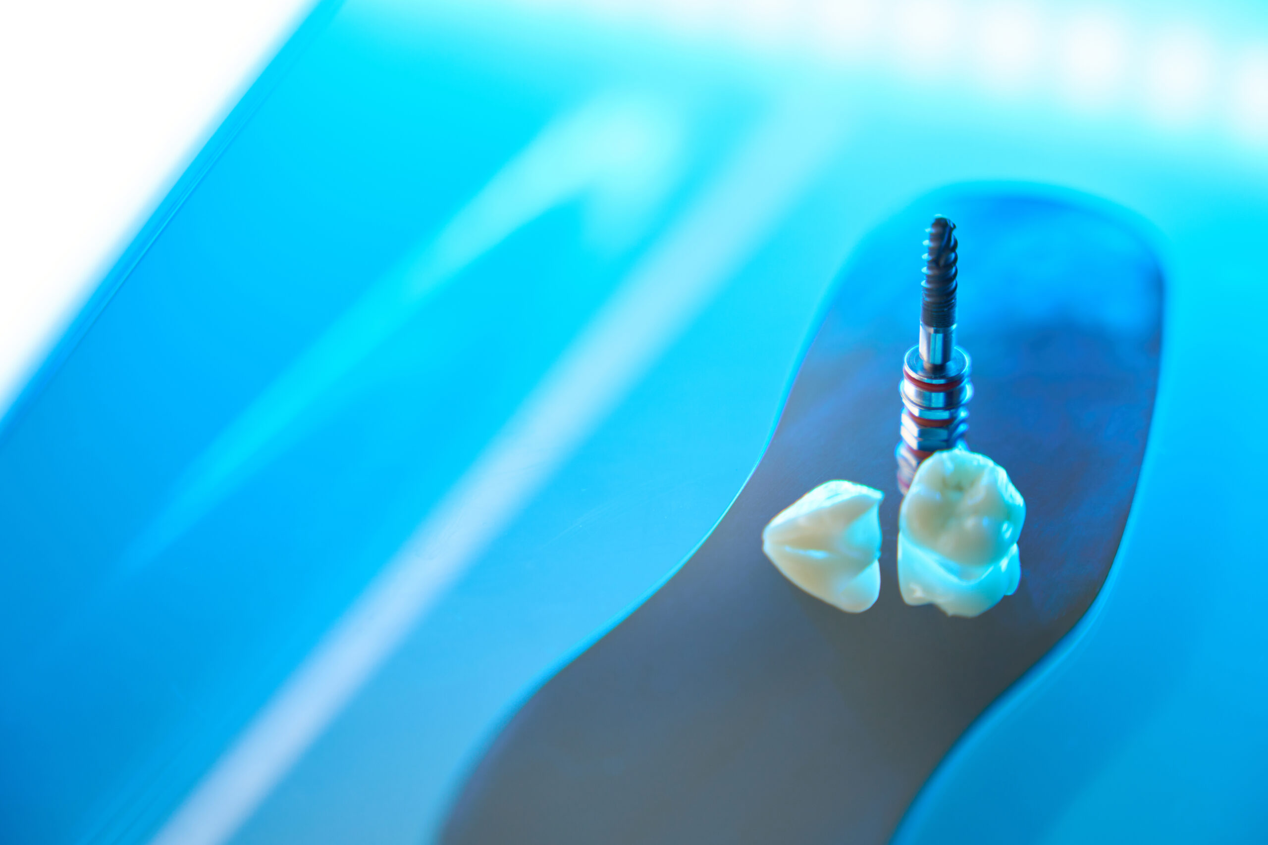 implantes dentales en Vigo