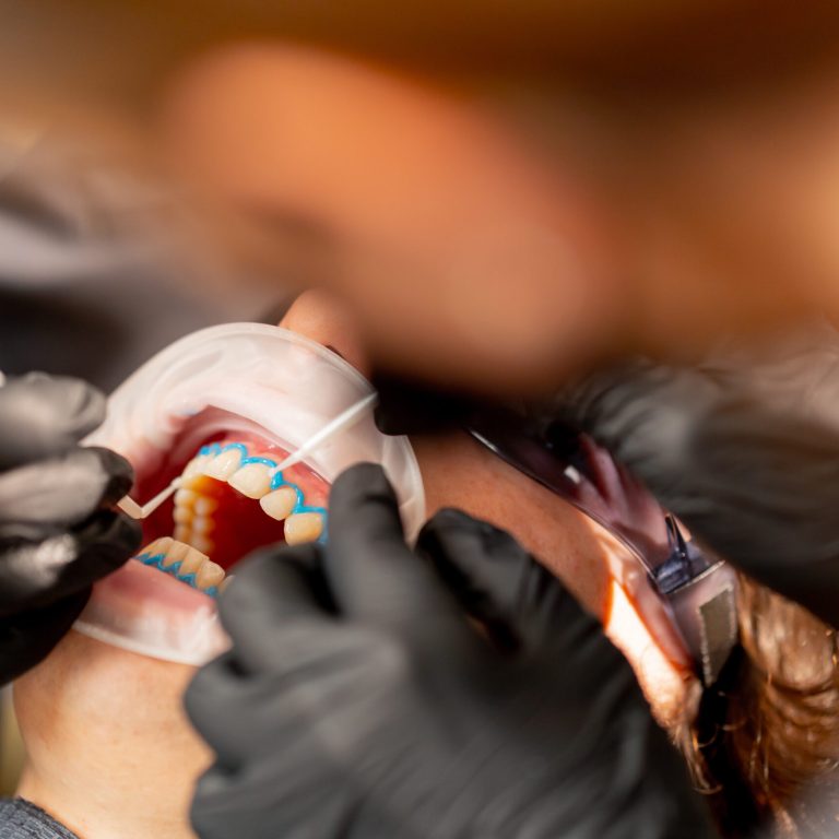 Dentista aplicando tratamiento protector en clínica dental en Vigo