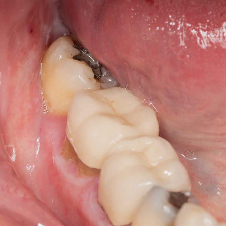 close-up-macro-shot-of-interior-of-mouth-and-filli-2026-01-11-10-15-39-utc