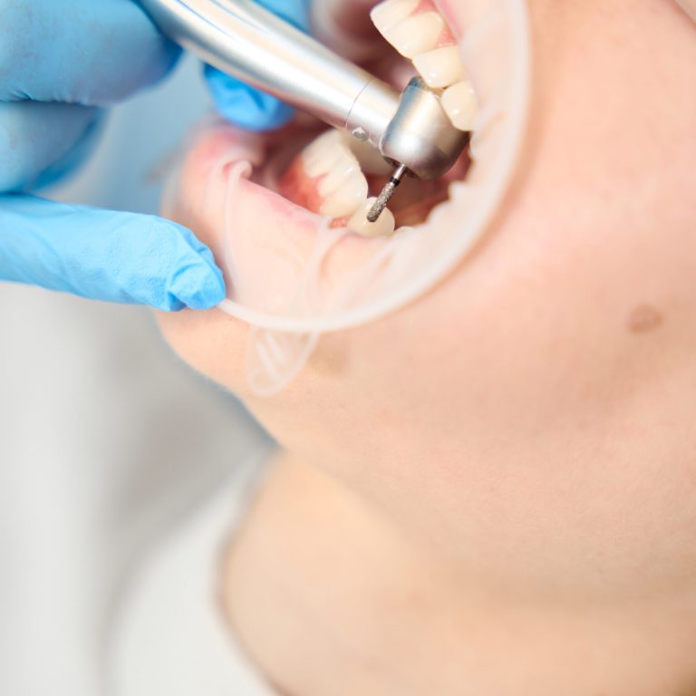 Las caries no aparecen de un día para otro. Descubre cómo se producen, cuáles son sus etapas y cómo prevenirlas con una buena higiene dental.