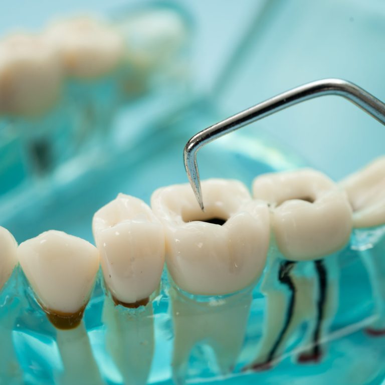 ¿Crees que tienes una caries? Descubre sus síntomas, causas y tratamientos. En Salvador Rico Odontología Integral somos dentistas en Vigo.