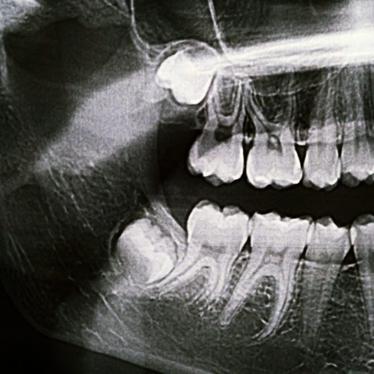 Panoramic X-ray of the jaw. X-ray of the teeth of a 12-year-old girl.