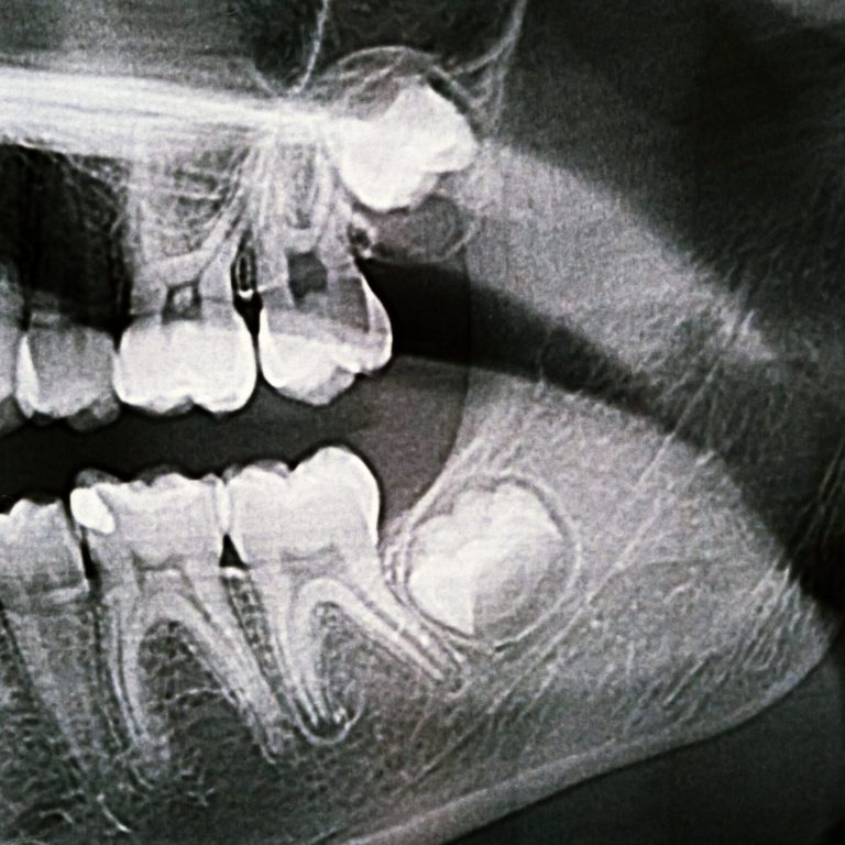 Panoramic X-ray of the jaw. X-ray of the teeth of a 12-year-old girl.