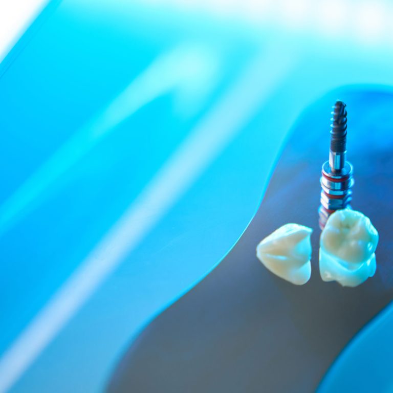 implantes dentales en Vigo
