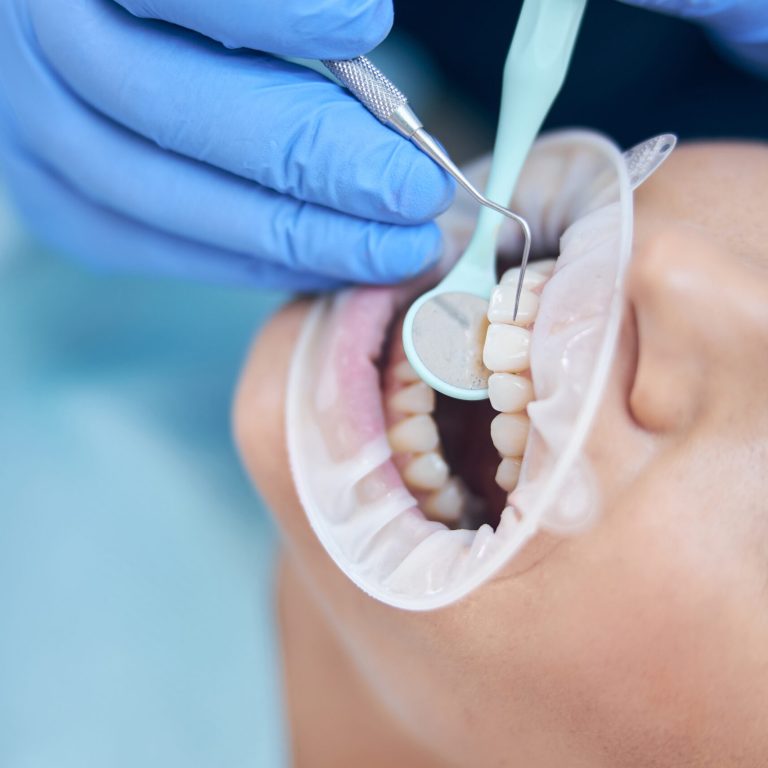Paciente recibiendo limpieza dental profesional en clínica dental en Vigo