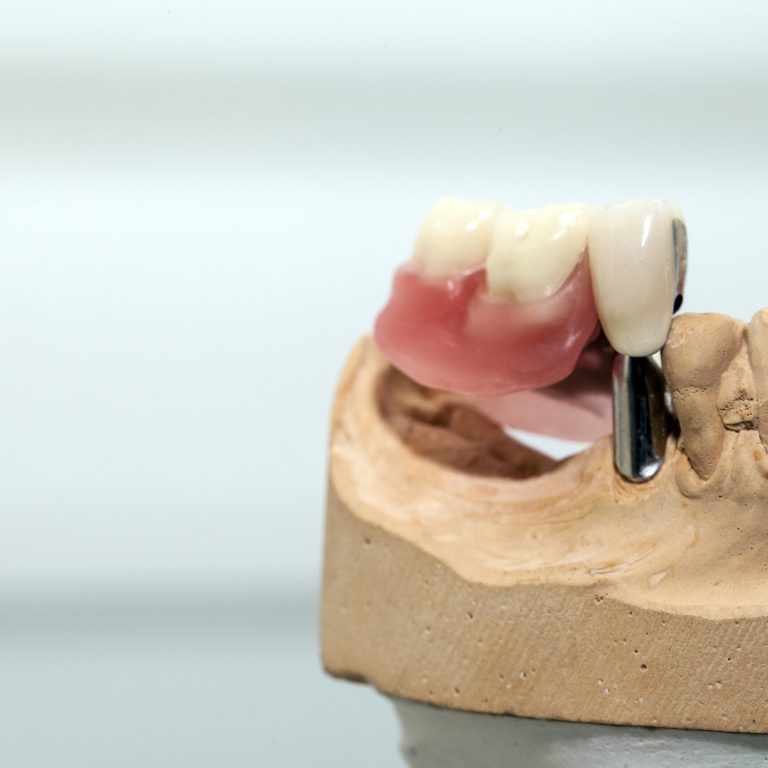 ¿Estás buscando una solución eficaz y duradera para reemplazar dientes perdidos? En Salvador Rico Odontología Integral te ofrecemos los mejores implantes en Vigo, con una atención personalizada, tecnología avanzada y resultados que transforman sonrisas. ¿Qué son los implantes dentales? Los implantes dentales son raíces artificiales de titanio que se colocan en el hueso maxilar o mandibular para sustituir dientes perdidos. Sobre ellos se coloca una corona que imita a la perfección la forma y función del diente natural. Son una de las opciones más seguras y duraderas en odontología, ya que ofrecen una solución fija, estética y funcional. Ventajas de los implantes dentales Optar por implantes en Vigo con un equipo profesional como el de nuestra clínica ofrece múltiples beneficios: Estabilidad y durabilidad: los implantes pueden durar toda la vida con los cuidados adecuados. Estética natural: la corona sobre implante se diseña para integrarse perfectamente con tu sonrisa. Prevención de la pérdida ósea: al estimular el hueso, se evita su reabsorción tras la pérdida dental. Comodidad y seguridad: no se mueven ni generan molestias al hablar o masticar. Mejora de la autoestima: una sonrisa completa influye positivamente en tu bienestar emocional. ¿Cuál es el proceso para colocar implantes? En Salvador Rico Odontología Integral realizamos un estudio personalizado para determinar la viabilidad del tratamiento: Diagnóstico digital completo: con radiografías y escáner 3D. Planificación del tratamiento: adaptado a tus necesidades y con todas las garantías. Cirugía mínimamente invasiva: realizada por profesionales especializados. Colocación de la prótesis: tras la integración del implante con el hueso (osteointegración). Nuestra prioridad es tu seguridad y comodidad. Utilizamos técnicas avanzadas y materiales de máxima calidad. ¿Por qué elegir nuestros implantes en Vigo? Con más de 15 años de experiencia, el Dr. Salvador Rico de Oñate lidera un equipo comprometido con la excelencia en cada tratamiento. Nuestra clínica combina tecnología de vanguardia con un trato humano y cercano, lo que nos convierte en una de las mejores opciones para realizar implantes dentales en Vigo. 📍 Estamos ubicados en el corazón de Vigo, con fácil acceso y horario flexible. 📞 Puedes pedir tu primera consulta sin compromiso para resolver todas tus dudas. Preguntas frecuentes sobre implantes dentales ¿Duelen los implantes dentales? No. Se realiza bajo anestesia local y el postoperatorio es generalmente leve. ¿Cuánto cuesta un implante dental? El precio varía según cada caso. Ofrecemos presupuestos personalizados y opciones de financiación. ¿Cuánto tarda el tratamiento completo? Entre 3 y 6 meses, dependiendo de la cicatrización y tipo de prótesis. ¿Listo para recuperar tu sonrisa? No esperes más para mejorar tu calidad de vida. En Salvador Rico Odontología Integral te ayudamos a volver a sonreír con confianza. Pide tu cita hoy mismo y descubre por qué somos tu mejor opción en implantes en Vigo.